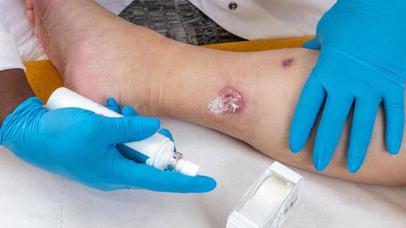 Idrosadenite suppurativa, quando fare la doccia o dormire diventano ostacoli