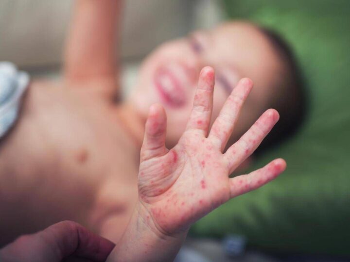 Morbillo, aumentano casi e ricoveri. Bassetti: “In Liguria focolaio senza precedenti, l’Italia rischia gravissima epidemia”