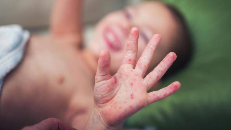 Morbillo, aumentano casi e ricoveri. Bassetti: “In Liguria focolaio senza precedenti, l’Italia rischia gravissima epidemia”