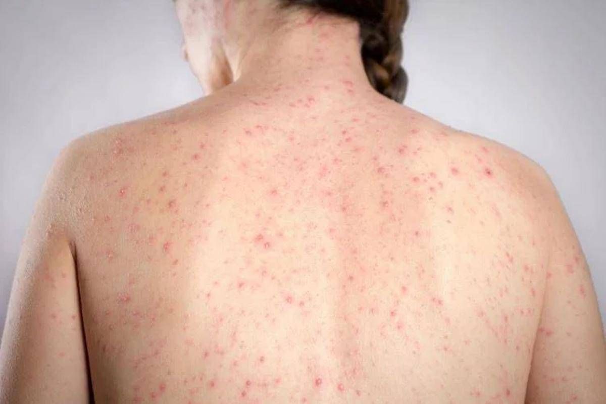 Morbillo, l’allarme dell’infettivologo Andreoni: “Casi in crescita, ricoveri frequenti negli adulti”